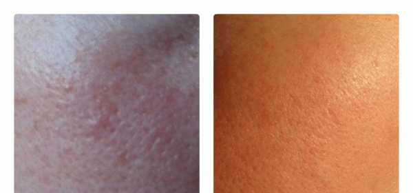 Помощь чувствительной коже с поврежденными капиллярами - Algologie Caress Day Cream фото